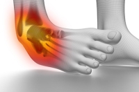 Severity Levels of Ankle Sprains and a Podiatrist’s Role