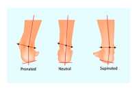 Excessive Supination Affects Your Foot Health